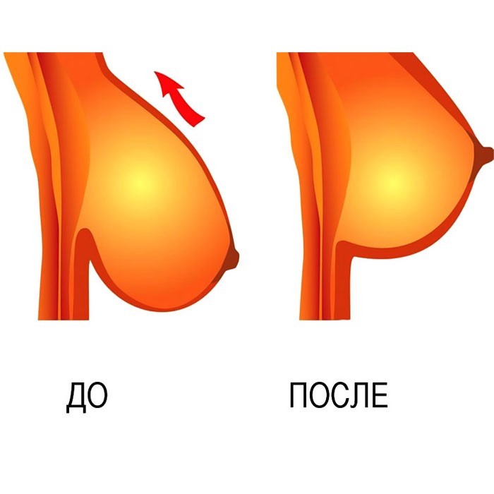    « » Bare Lifts